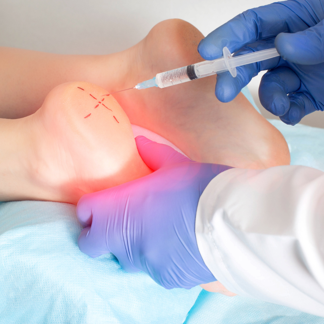 Exploring Steroid Injections for Foot and Ankle Pain: Conditions and Considerations