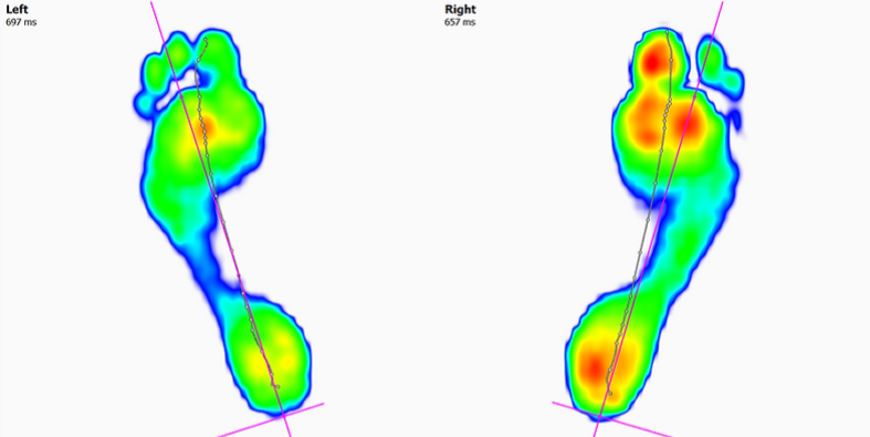 Revolutionising Biomechanics with 3D Printed Insoles: The Impact of Phits Insoles
